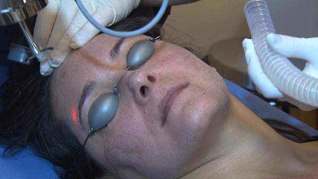 Arctic Peel Takes Sting Out Of Laser Procedure