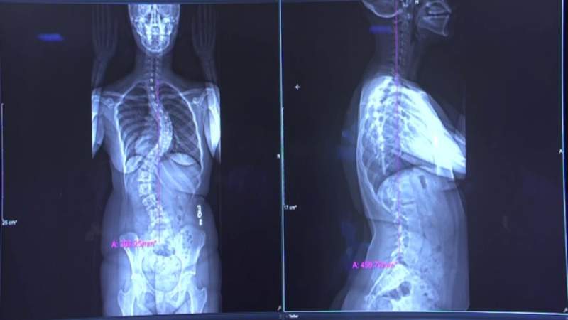 Alternative scoliosis treatment is under review