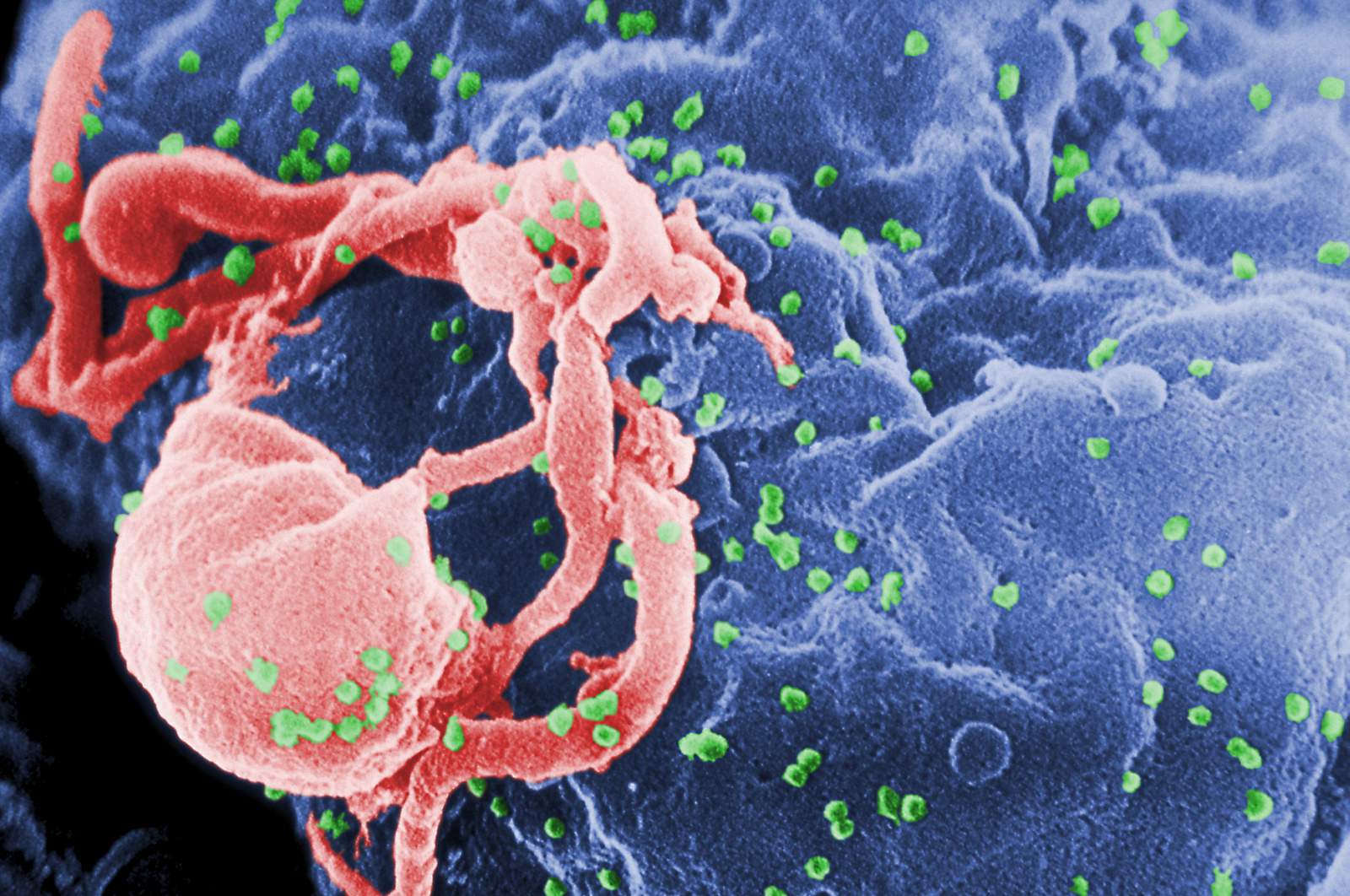 Study finds long-acting shot helps women avoid HIV infection