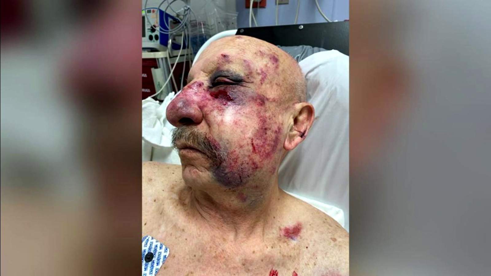 Family of elderly man attacked on Metromover suing Miami-Dade and security company