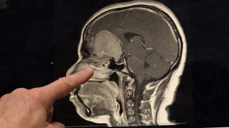 UHealth Neurosurgeon Performs Surgery to Remove Meningiomas