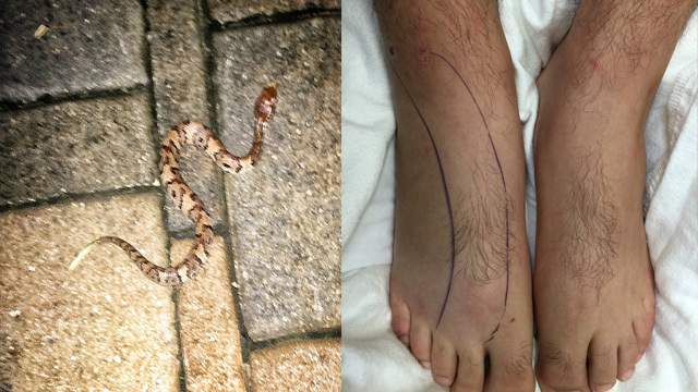 Water Moccasin Bites 17 Year Old Boy In Miramar