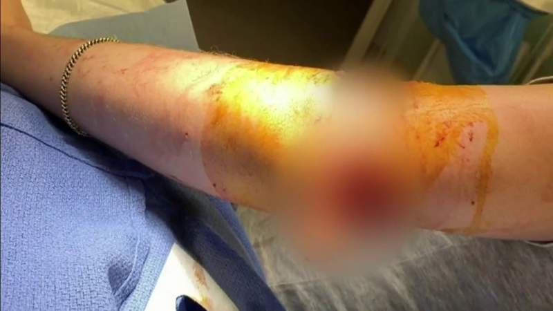 Woman visiting South Florida recounts being attacked by dog outside Everglades Holiday Park