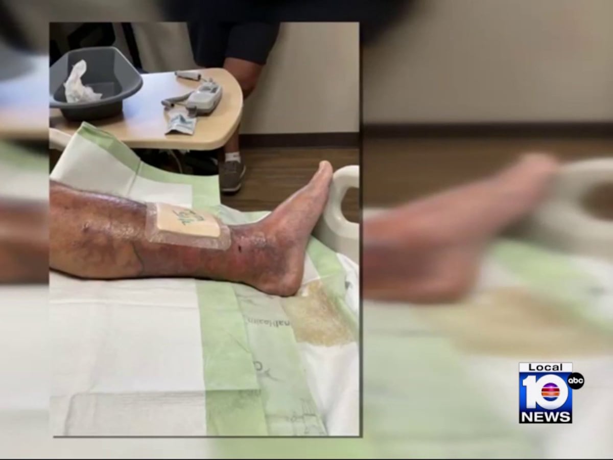 Image linked from the original feed: ‘Flesh-eating’ bacteria infections in Florida: 1 dead, 12 confirmed cases, health officials report