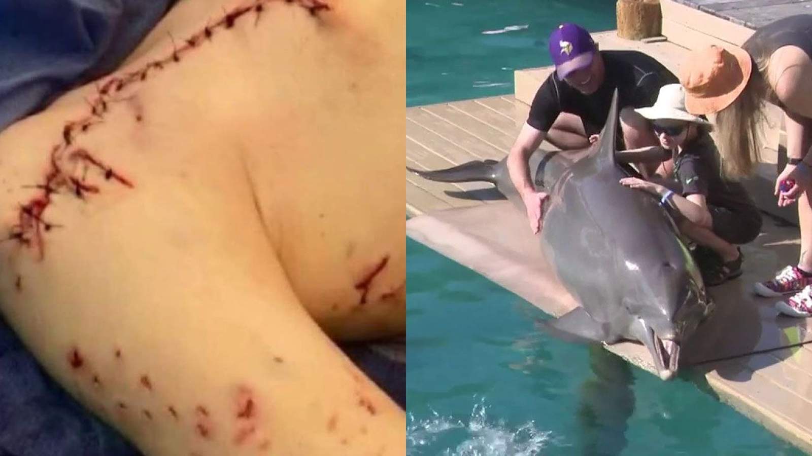 After surviving shark attack in Miami Beach, boy gets to play with dolphins